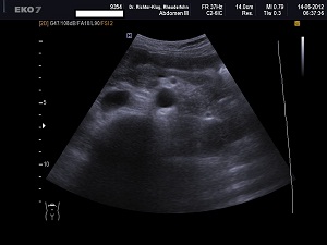 Ultraschall Bauch Bauchspeicheldrüse