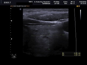 Ultraschall Schilddrüse links quer Ultraschall Schilddrüse links quer