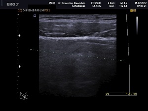 Ultraschall Schilddrüse links längs Ultraschall Schilddrüse links längs